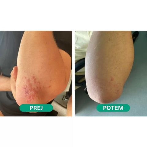 Therapeutic CBD ointment for skin